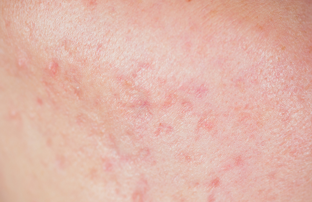 Nahaufnahme von unreiner Haut mit sichtbaren Rötungen, kleinen Pickeln und ungleichmäßiger Struktur.